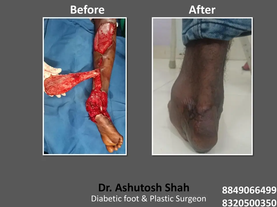 Diabetic Foot  PPT sunita.pptx-57.webp